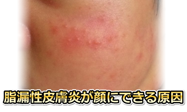 顔の脂漏性皮膚炎の原因