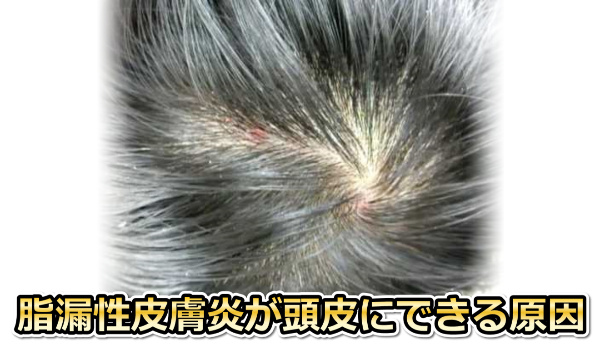 頭皮の脂漏性皮膚炎の原因
